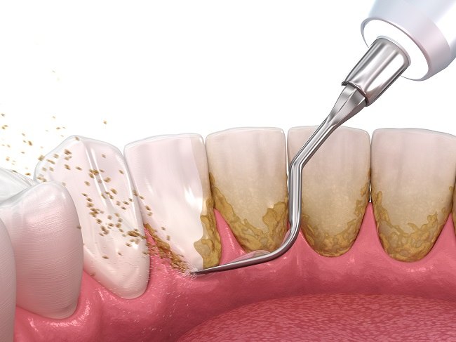 ketahui apa itu scaling gigi - Tips Perawatan Setelah Menjalani Scaling gigi